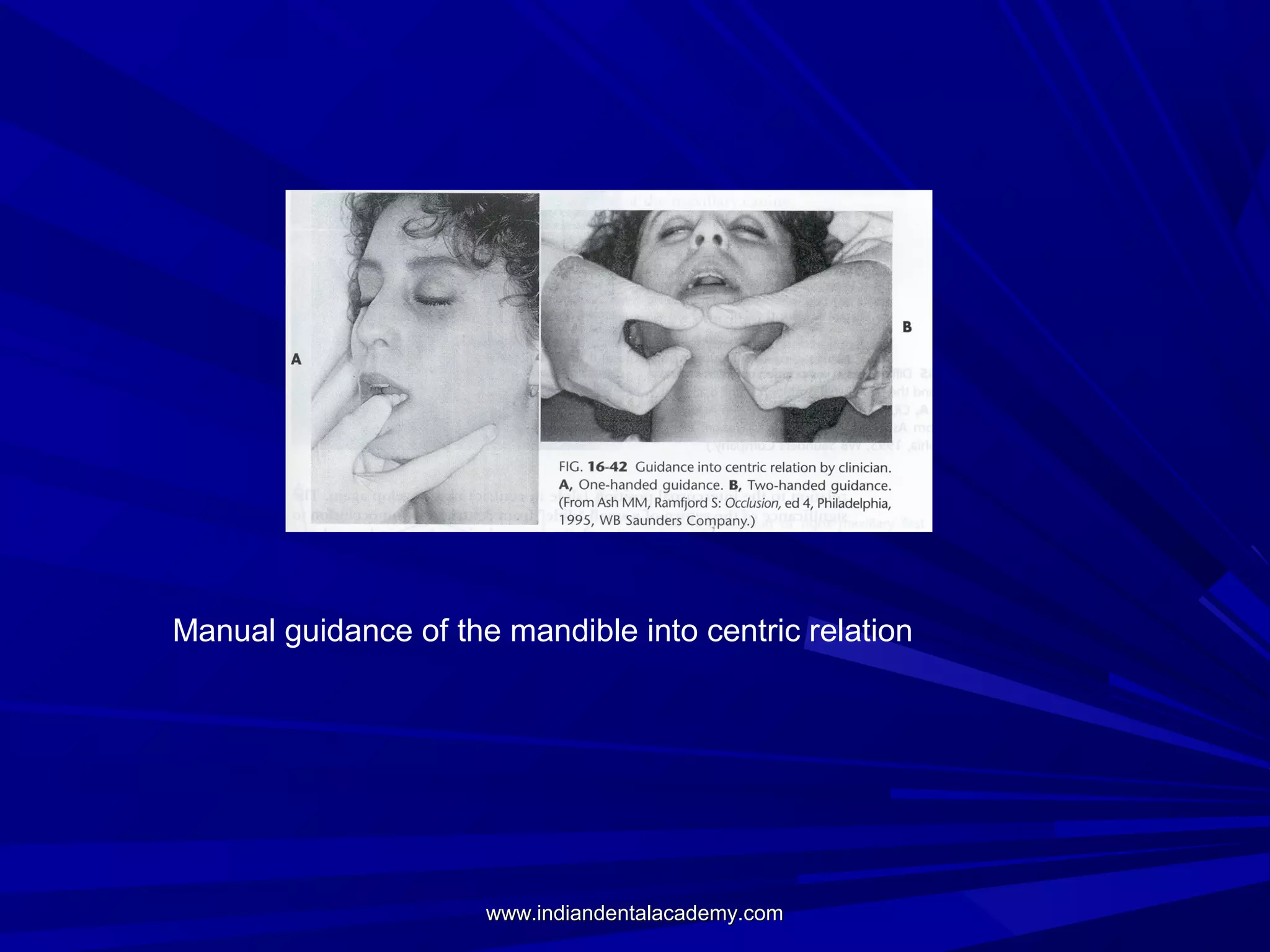 Manual guidance of the mandible into centric relation

www.indiandentalacademy.com

 