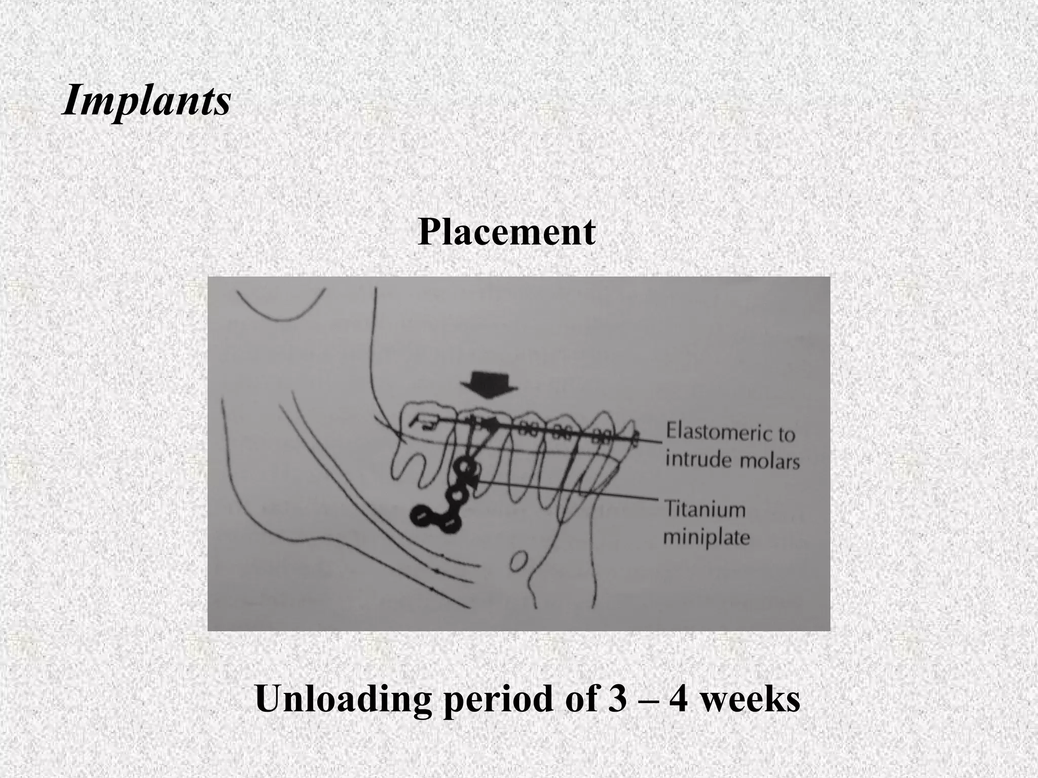 Implants
Placement

Unloading period of 3 – 4 weeks

 
