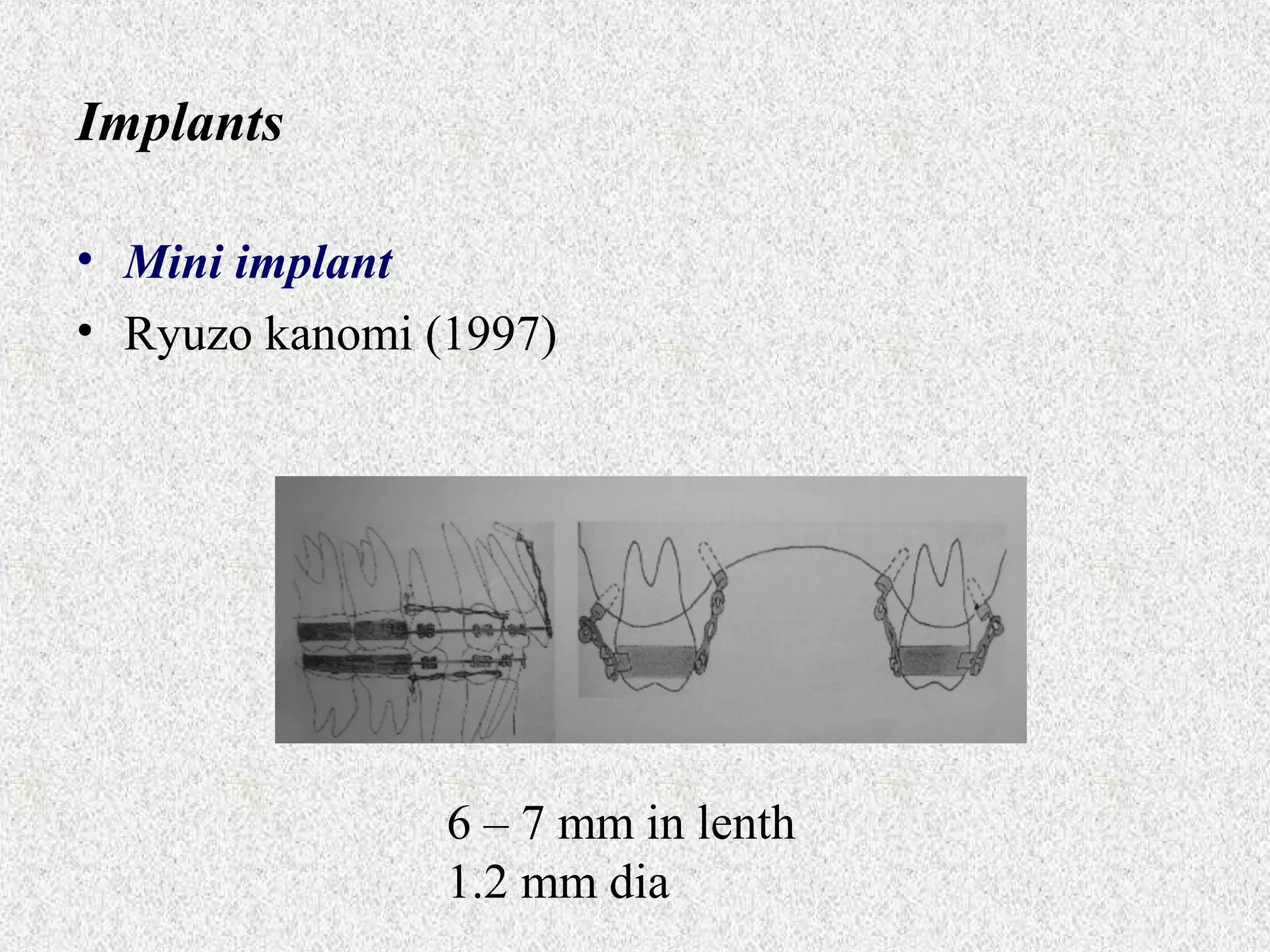 Implants
• Mini implant
• Ryuzo kanomi (1997)

6 – 7 mm in lenth
1.2 mm dia

 