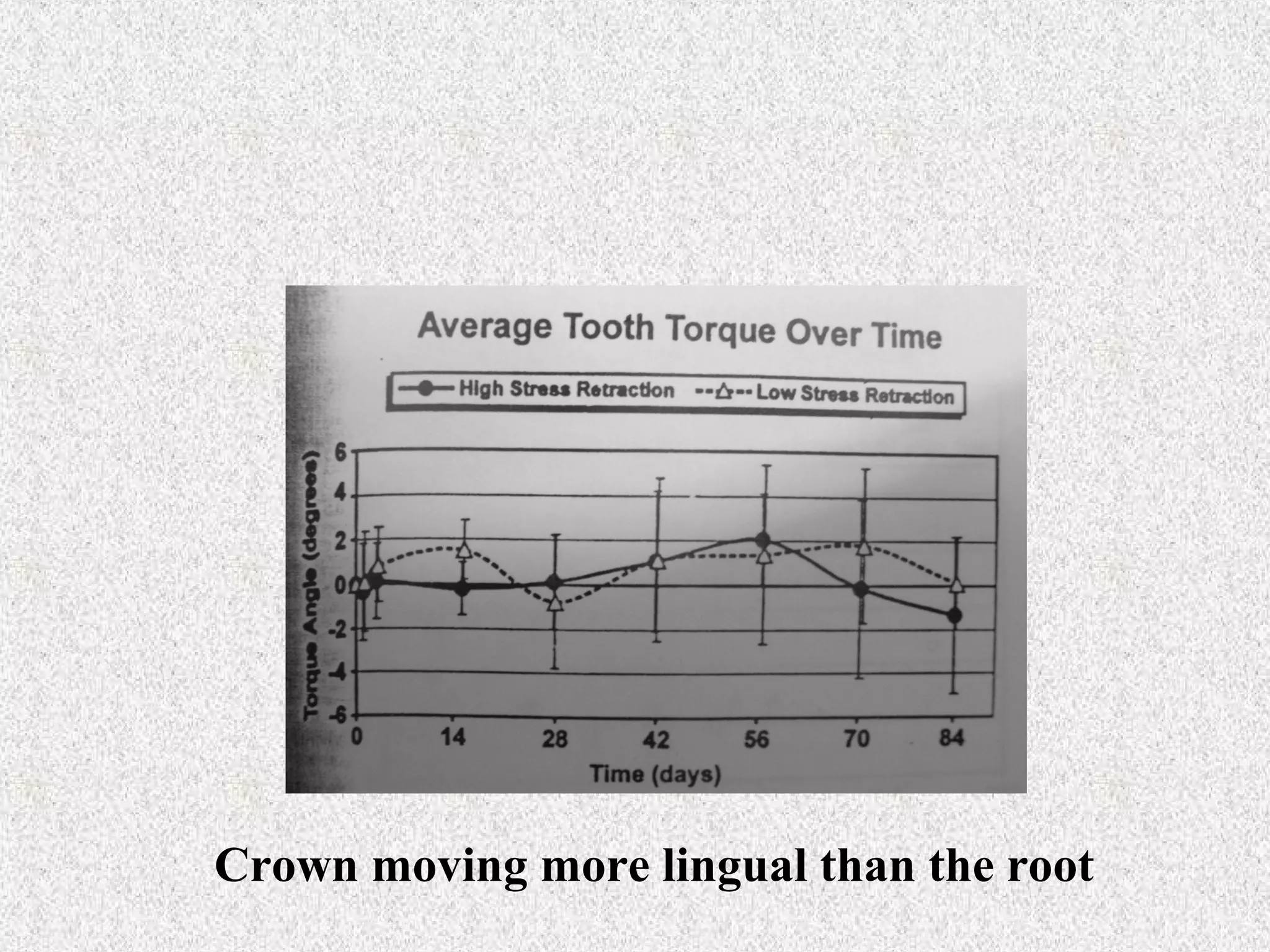 Crown moving more lingual than the root

 