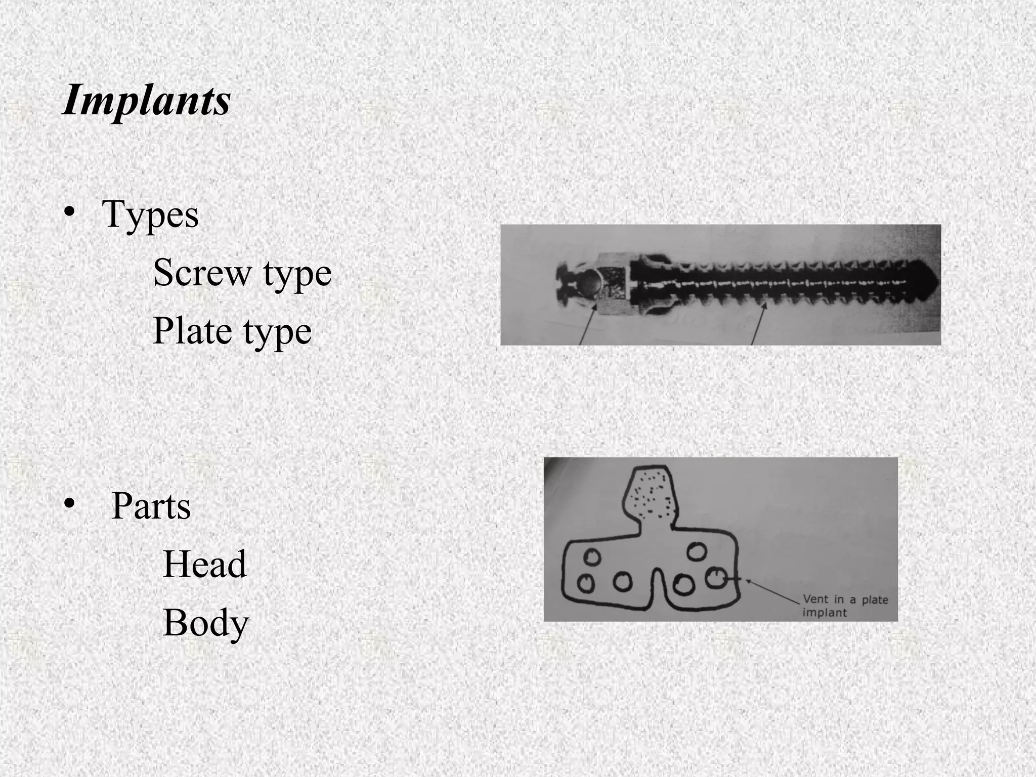 Implants
• Types
Screw type
Plate type

• Parts
Head
Body

 
