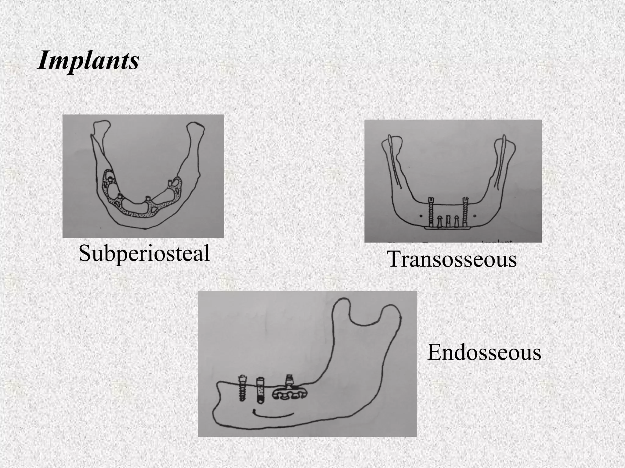 Implants

Subperiosteal

Transosseous

Endosseous

 