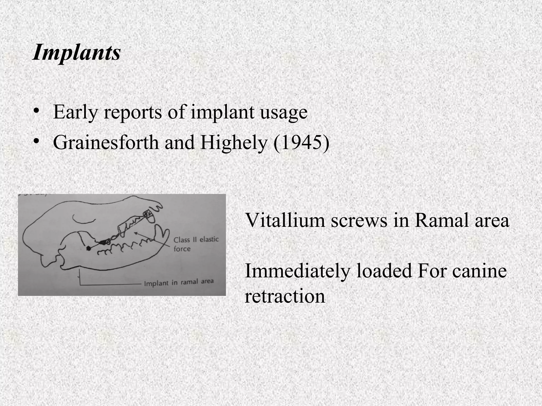 Implants
• Early reports of implant usage
• Grainesforth and Highely (1945)

Vitallium screws in Ramal area
Immediately loaded For canine
retraction

 