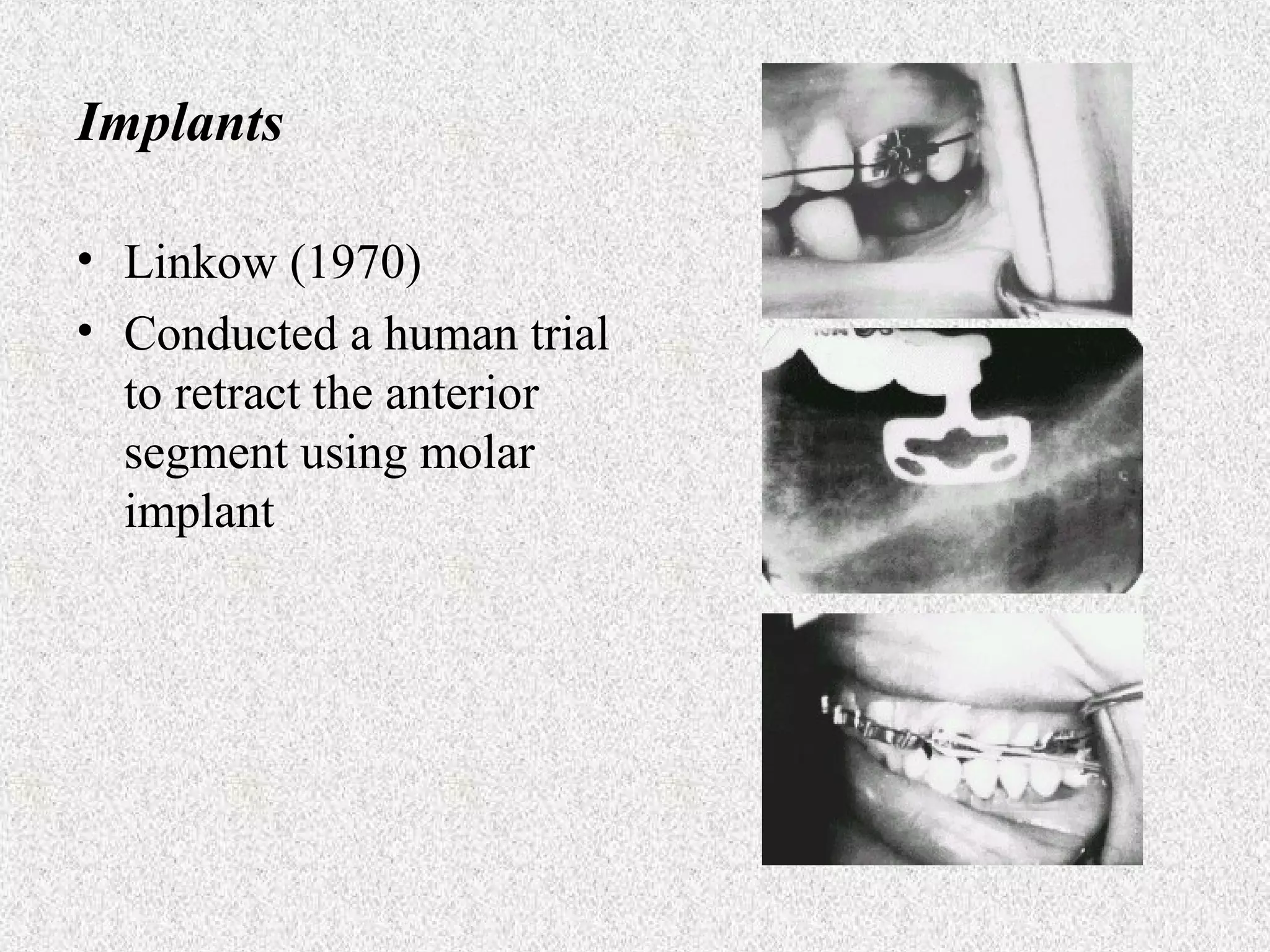 Implants
• Linkow (1970)
• Conducted a human trial
to retract the anterior
segment using molar
implant

 