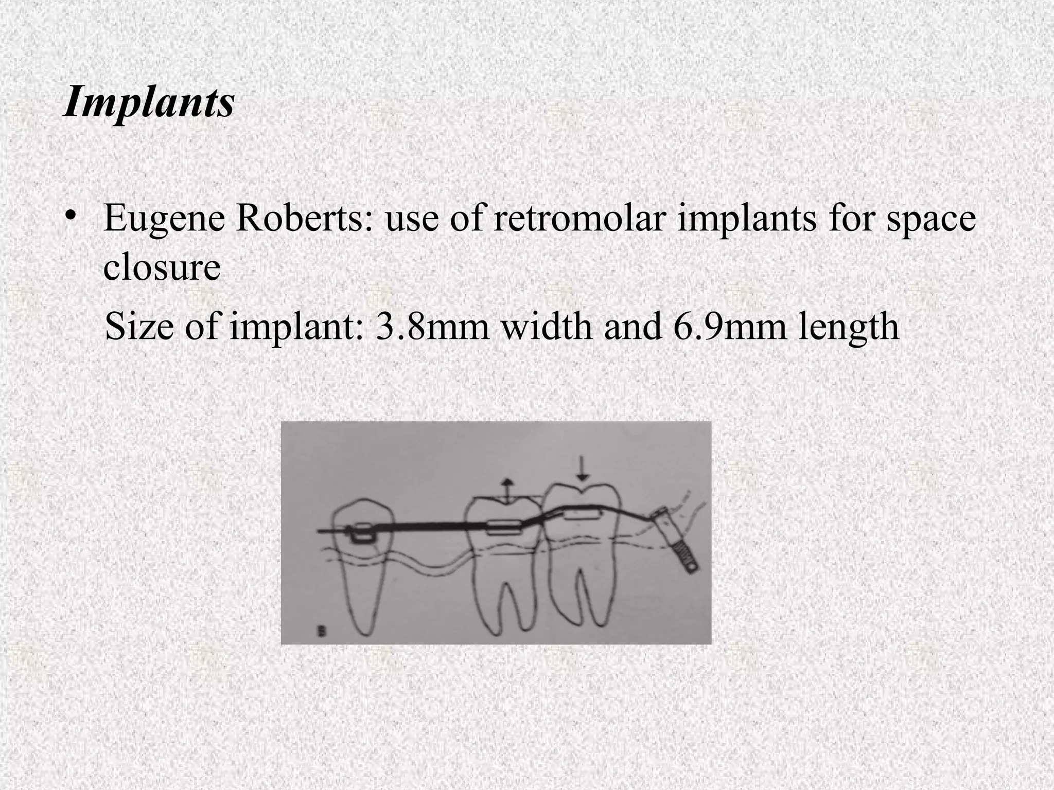 Implants
• Eugene Roberts: use of retromolar implants for space
closure
Size of implant: 3.8mm width and 6.9mm length

 