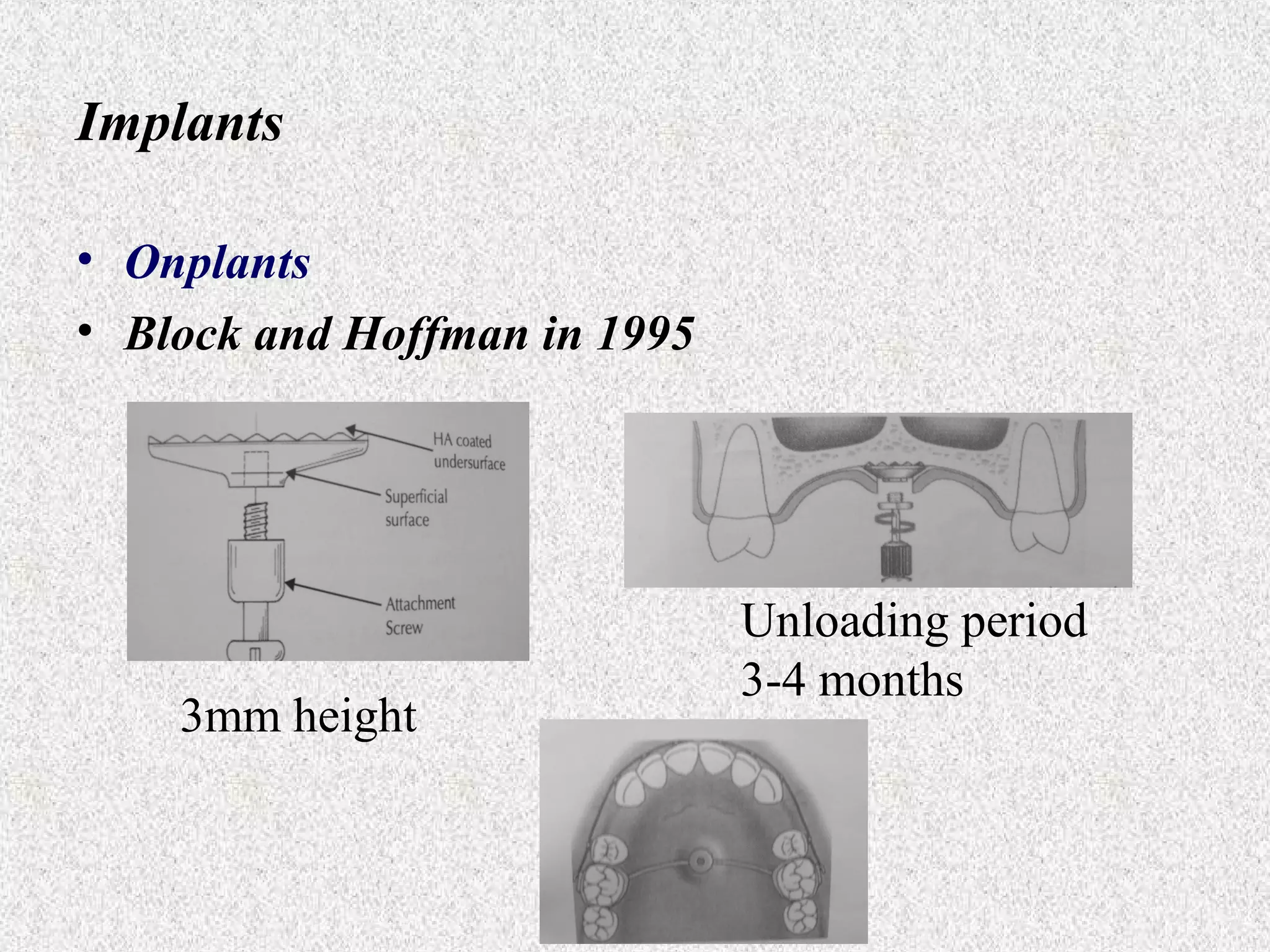 Implants
• Onplants
• Block and Hoffman in 1995

3mm height

Unloading period
3-4 months

 