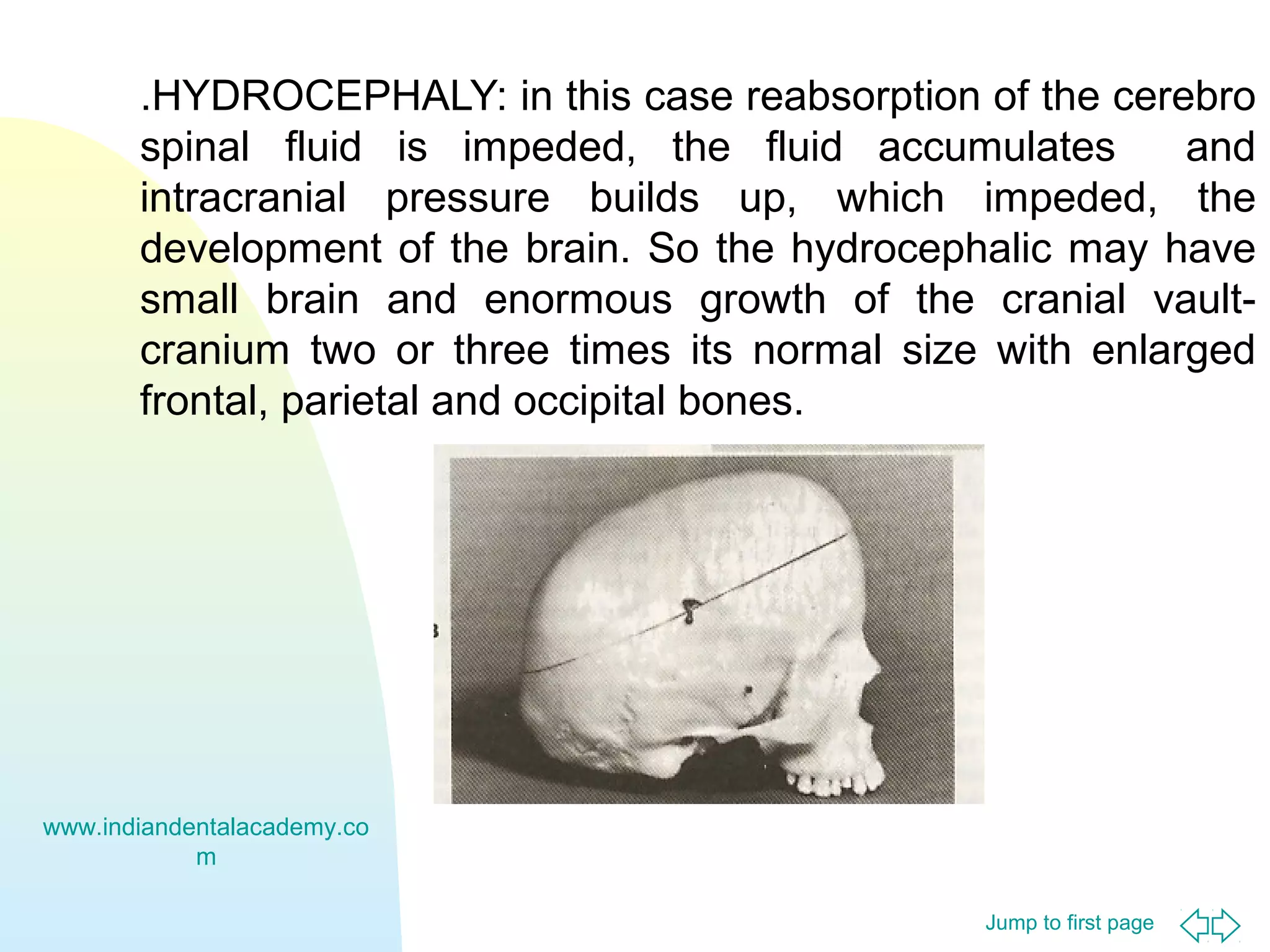 Jump to first page
.HYDROCEPHALY: in this case reabsorption of the cerebro
spinal fluid is impeded, the fluid accumulates and
intracranial pressure builds up, which impeded, the
development of the brain. So the hydrocephalic may have
small brain and enormous growth of the cranial vault-
cranium two or three times its normal size with enlarged
frontal, parietal and occipital bones.
www.indiandentalacademy.co
m
 