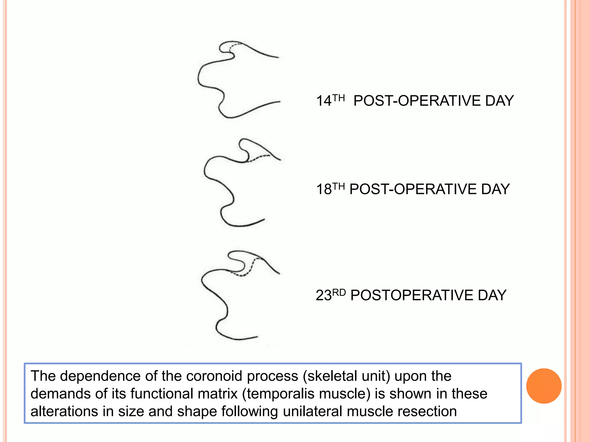 The dependence of the coronoid process (skeletal unit) upon the
demands of its functional matrix (temporalis muscle) is shown in these
alterations in size and shape following unilateral muscle resection
14TH POST-OPERATIVE DAY
18TH POST-OPERATIVE DAY
23RD POSTOPERATIVE DAY
 