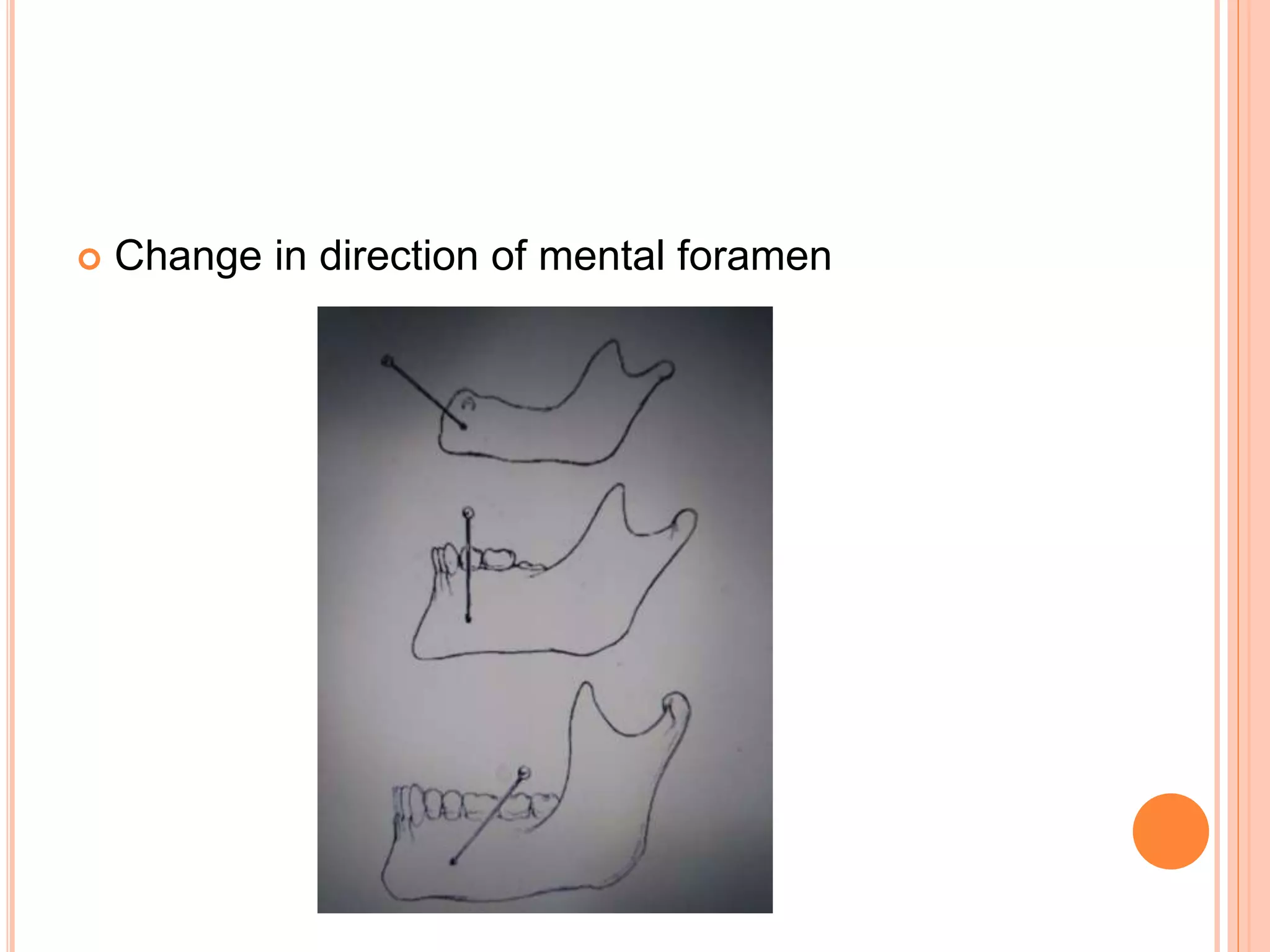  Change in direction of mental foramen
 