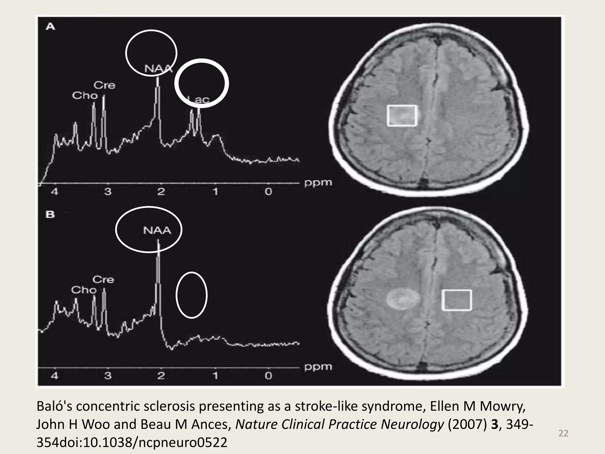22
Baló's concentric sclerosis presenting as a stroke-like syndrome, Ellen M Mowry,
John H Woo and Beau M Ances, Nature Clinical Practice Neurology (2007) 3, 349-
354doi:10.1038/ncpneuro0522
 