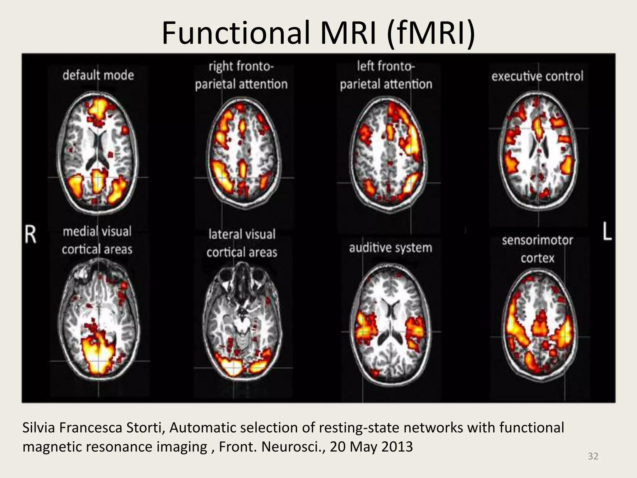 Functional MRI (fMRI)
32
Silvia Francesca Storti, Automatic selection of resting-state networks with functional
magnetic resonance imaging , Front. Neurosci., 20 May 2013
 