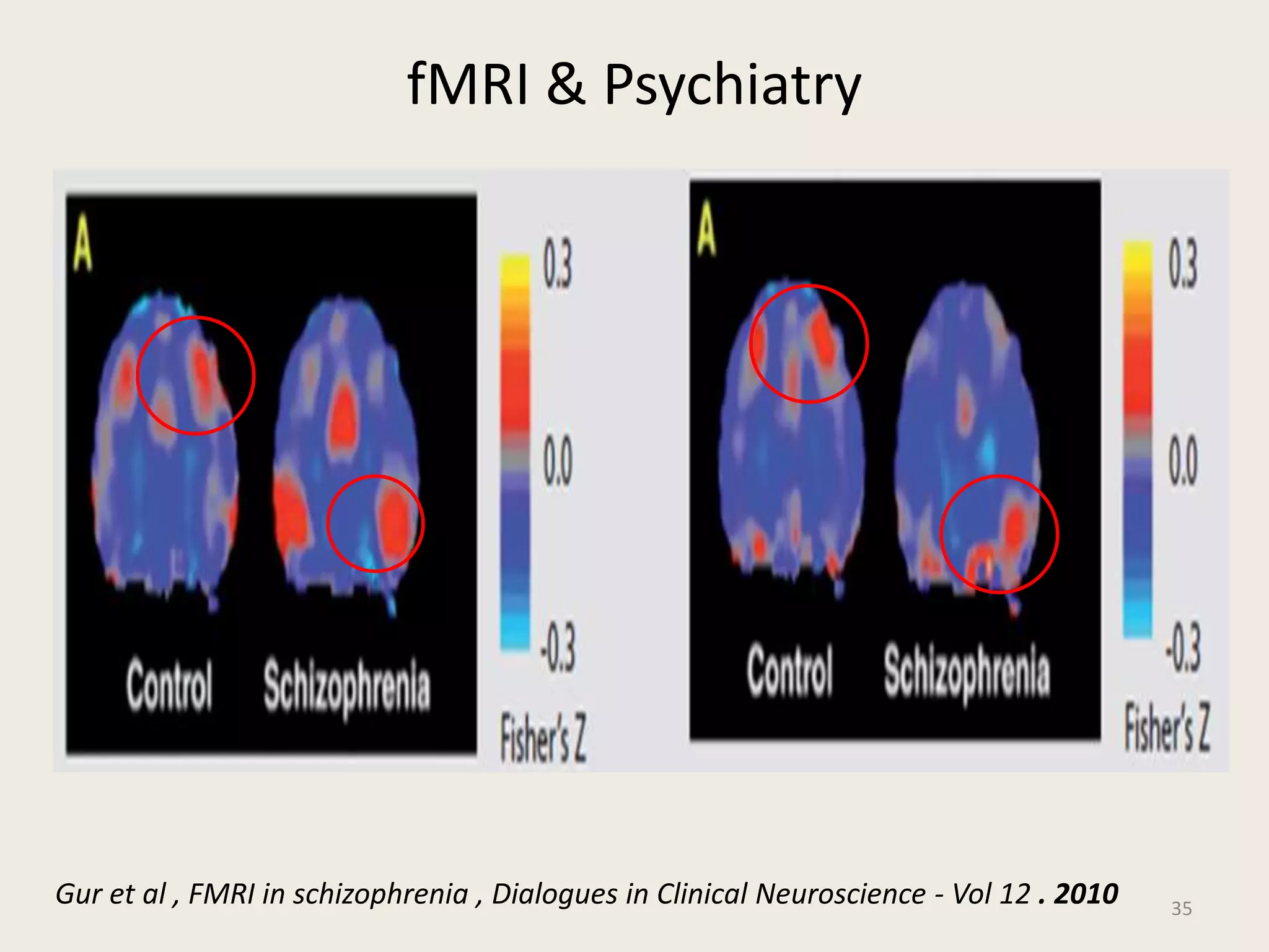 fMRI & Psychiatry
35
Gur et al , FMRI in schizophrenia , Dialogues in Clinical Neuroscience - Vol 12 . 2010
 