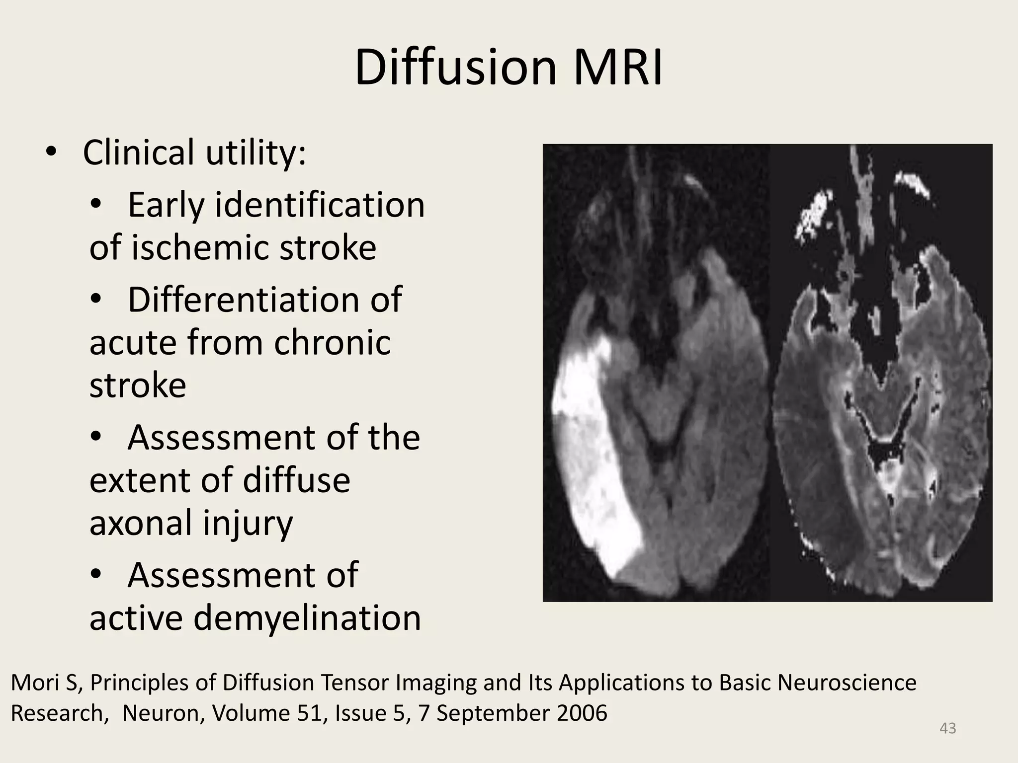 Diffusion MRI
• Clinical utility:
• Early identification
of ischemic stroke
• Differentiation of
acute from chronic
stroke
• Assessment of the
extent of diffuse
axonal injury
• Assessment of
active demyelination
43
Mori S, Principles of Diffusion Tensor Imaging and Its Applications to Basic Neuroscience
Research, Neuron, Volume 51, Issue 5, 7 September 2006
 