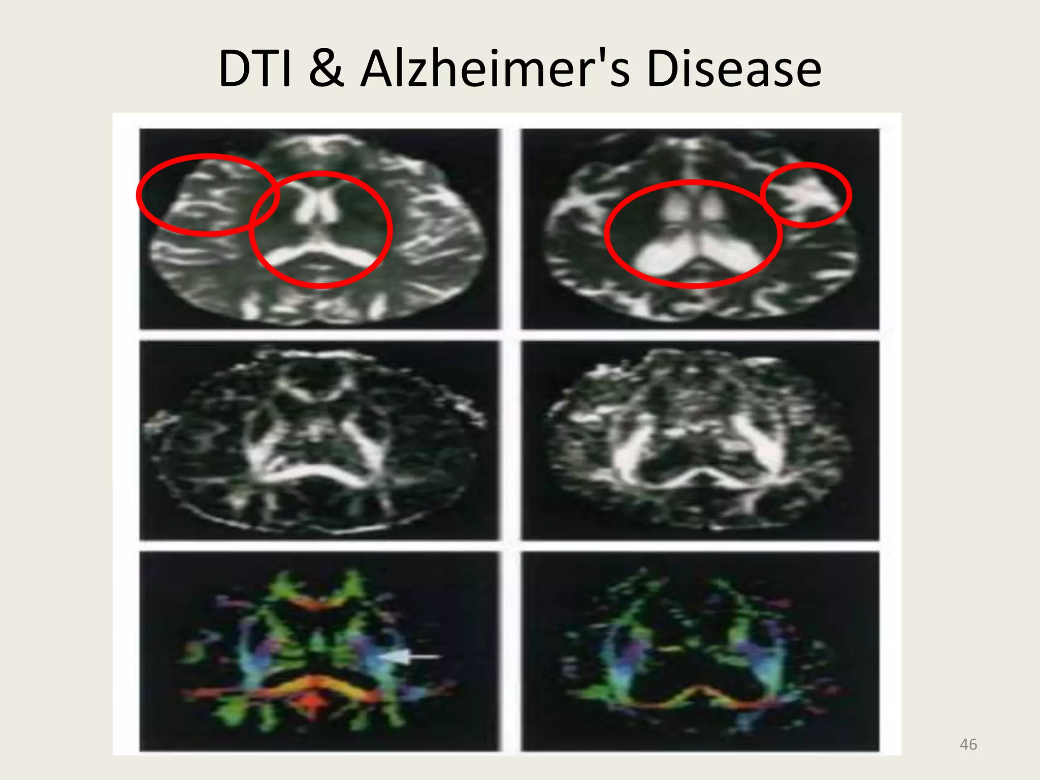 46
DTI & Alzheimer's Disease
 
