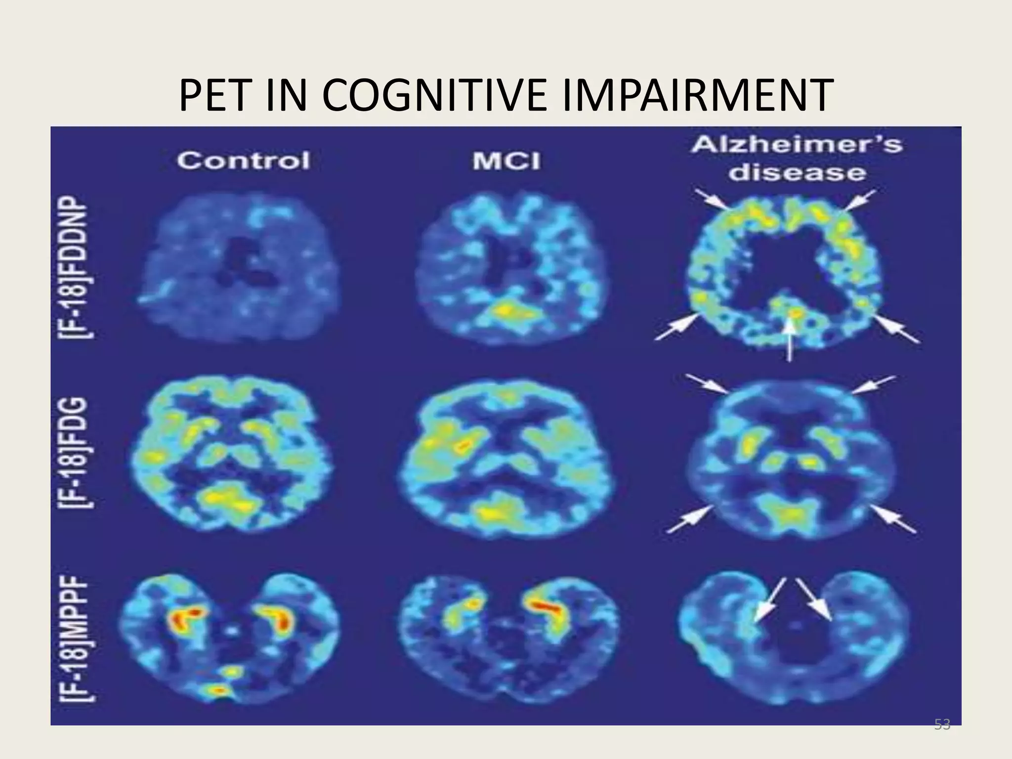 PET IN COGNITIVE IMPAIRMENT
53
 