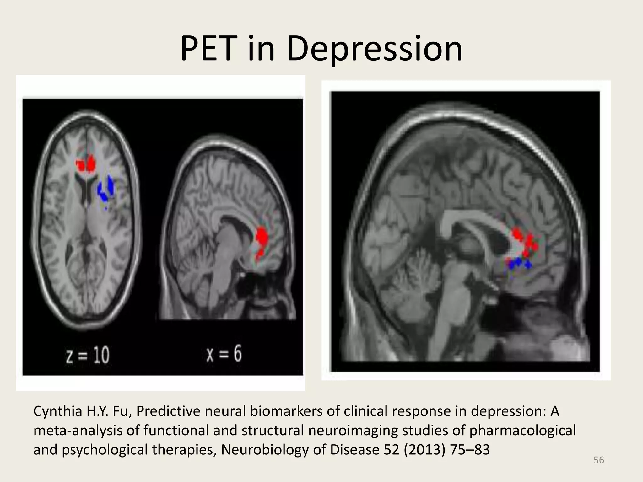 PET in Depression
56
Cynthia H.Y. Fu, Predictive neural biomarkers of clinical response in depression: A
meta-analysis of functional and structural neuroimaging studies of pharmacological
and psychological therapies, Neurobiology of Disease 52 (2013) 75–83
 
