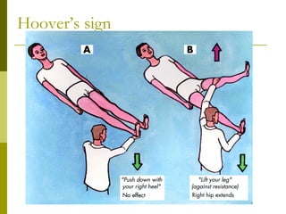 Hoover’s sign
 