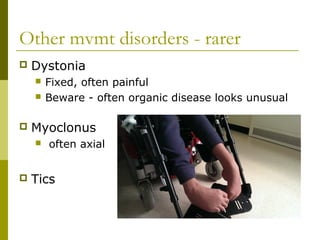 Other mvmt disorders - rarer
 Dystonia
 Fixed, often painful
 Beware - often organic disease looks unusual
 Myoclonus
 often axial
 Tics
 