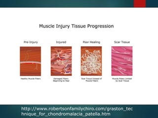 http://www.robertsonfamilychiro.com/graston_tec
hnique_for_chondromalacia_patella.htm
 
