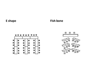 E shape Fish bone
 