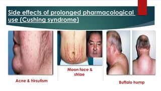 Side effects of prolonged pharmacological
use (Cushing syndrome)
Acne & hirsutism
Moon face &
striae
Buffalo hump
 