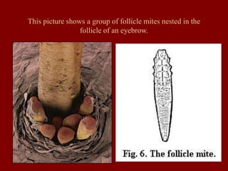 This picture shows a group of follicle mites nested in the
follicle of an eyebrow.
 