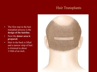 Hair Transplants
• The first step in the hair
transplant process is the
design of the hairline.
• Next the donor area is
prepared.
• Hair in the back is lifted
and a narrow strip of hair
is trimmed to about
1/16th of an inch.
 