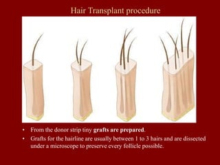 Hair Transplant procedure
• From the donor strip tiny grafts are prepared.
• Grafts for the hairline are usually between 1 to 3 hairs and are dissected
under a microscope to preserve every follicle possible.
 