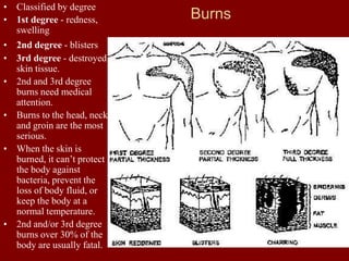Burns
• Classified by degree
• 1st degree - redness,
swelling
• 2nd degree - blisters
• 3rd degree - destroyed
skin tissue.
• 2nd and 3rd degree
burns need medical
attention.
• Burns to the head, neck
and groin are the most
serious.
• When the skin is
burned, it can’t protect
the body against
bacteria, prevent the
loss of body fluid, or
keep the body at a
normal temperature.
• 2nd and/or 3rd degree
burns over 30% of the
body are usually fatal.
 