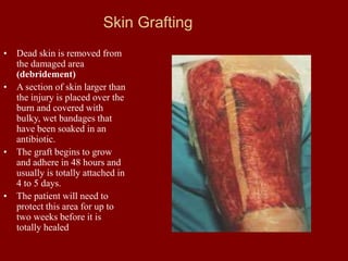 Skin Grafting
• Dead skin is removed from
the damaged area
(debridement)
• A section of skin larger than
the injury is placed over the
burn and covered with
bulky, wet bandages that
have been soaked in an
antibiotic.
• The graft begins to grow
and adhere in 48 hours and
usually is totally attached in
4 to 5 days.
• The patient will need to
protect this area for up to
two weeks before it is
totally healed
 