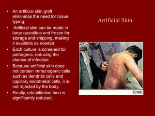 Artificial Skin
• An artificial skin graft
eliminates the need for tissue
typing.
• Artificial skin can be made in
large quantities and frozen for
storage and shipping, making
it available as needed.
• Each culture is screened for
pathogens, reducing the
chance of infection.
• Because artificial skin does
not contain immunogenic cells
such as dendritic cells and
capillary endothelial cells, it is
not rejected by the body.
• Finally, rehabilitation time is
significantly reduced.
 