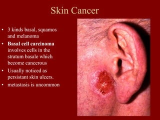 Skin Cancer
• 3 kinds basal, squamos
and melanoma
• Basal cell carcinoma
involves cells in the
stratum basale which
become cancerous
• Usually noticed as
persistant skin ulcers.
• metastasis is uncommon
 