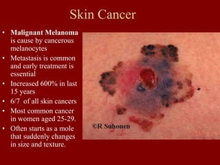 Skin Cancer
• Malignant Melanoma
is cause by cancerous
melanocytes
• Metastasis is common
and early treatment is
essential
• Increased 600% in last
15 years
• 6/7 of all skin cancers
• Most common cancer
in women aged 25-29.
• Often starts as a mole
that suddenly changes
in size and texture.
 