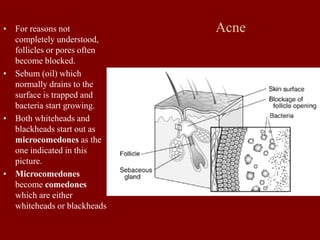 Acne
• For reasons not
completely understood,
follicles or pores often
become blocked.
• Sebum (oil) which
normally drains to the
surface is trapped and
bacteria start growing.
• Both whiteheads and
blackheads start out as
microcomedones as the
one indicated in this
picture.
• Microcomedones
become comedones
which are either
whiteheads or blackheads
 