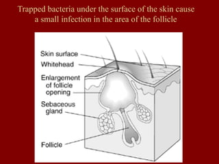 Trapped bacteria under the surface of the skin cause
a small infection in the area of the follicle
 