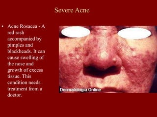 Severe Acne
• Acne Rosacea - A
red rash
accompanied by
pimples and
blackheads. It can
cause swelling of
the nose and
growth of excess
tissue. This
condition needs
treatment from a
doctor.
 