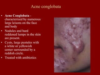 Acne conglobata
• Acne Conglobata -
characterized by numerous
large leisons on the face
and body
• Nodules and hard
reddened lumps in the skin
are present.
• Cysts, large pustules with
a white or yellowish
center surrounded by a
reddish circle.
• Treated with antibiotics
 
