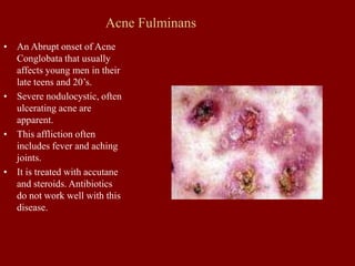 Acne Fulminans
• An Abrupt onset of Acne
Conglobata that usually
affects young men in their
late teens and 20’s.
• Severe nodulocystic, often
ulcerating acne are
apparent.
• This affliction often
includes fever and aching
joints.
• It is treated with accutane
and steroids. Antibiotics
do not work well with this
disease.
 