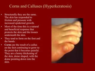 Corns and Calluses (Hyperkeratosis)
• Structurally they are the same.
The skin has responded to
friction and pressure with
increased epidermal growth.
• Most of the time this is a natural
and beneficial response that
protects the skin and the tissues
underneath the skin.
• They tend to form on the foot and
the hands.
• Corns are the result of a callus
on the foot continuing to grow to
the point that it becomes painful.
They are a horny thickening of
the skin, dome shaped, with the
dome pointing down into the
skin.
 