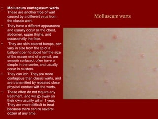 Molluscum warts
• Molluscum contagiosum warts
These are another type of wart
caused by a different virus from
the classic wart.
• They have a different appearance
and usually occur on the chest,
abdomen, upper thighs, and
occasionally the face.
• They are skin-colored bumps, can
vary in size from the tip of a
ballpoint pen to about half the size
of the eraser end of a pencil, are
smooth surfaced, often have a
dimple in the center, and usually
occur in clusters.
• They can itch. They are more
contagious than classic warts, and
are transmitted by repeated close
physical contact with the warts.
• These often do not require any
treatment, and will go away on
their own usually within 1 year.
They are more difficult to treat
because there can be several
dozen at any time.
 