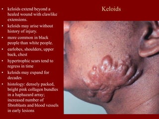 Keloids
• keloids extend beyond a
healed wound with clawlike
extensions.
• keloids may arise without
history of injury.
• more common in black
people than white people.
• earlobes, shoulders, upper
back, chest
• hypertrophic scars tend to
regress in time
• keloids may expand for
decades
• histology: densely packed,
bright pink collagen bundles
in a haphazard array;
increased number of
fibroblasts and blood vessels
in early lesions
 