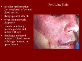 Port Wine Stain
• vascular malformation
(not neoplasm) of dermal
blood vessels
• always present at birth
• never spontaneously
disappears
• macular in infancy;
become papular and
darker with age
• histology: increased
number of blood vessels,
with larger lumens, in
upper dermis
 