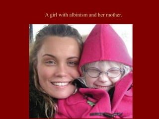 A girl with albinism and her mother.
 