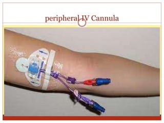 peripheral IV Cannula
 