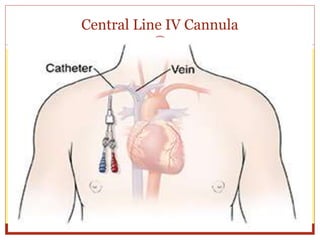 Central Line IV Cannula
 