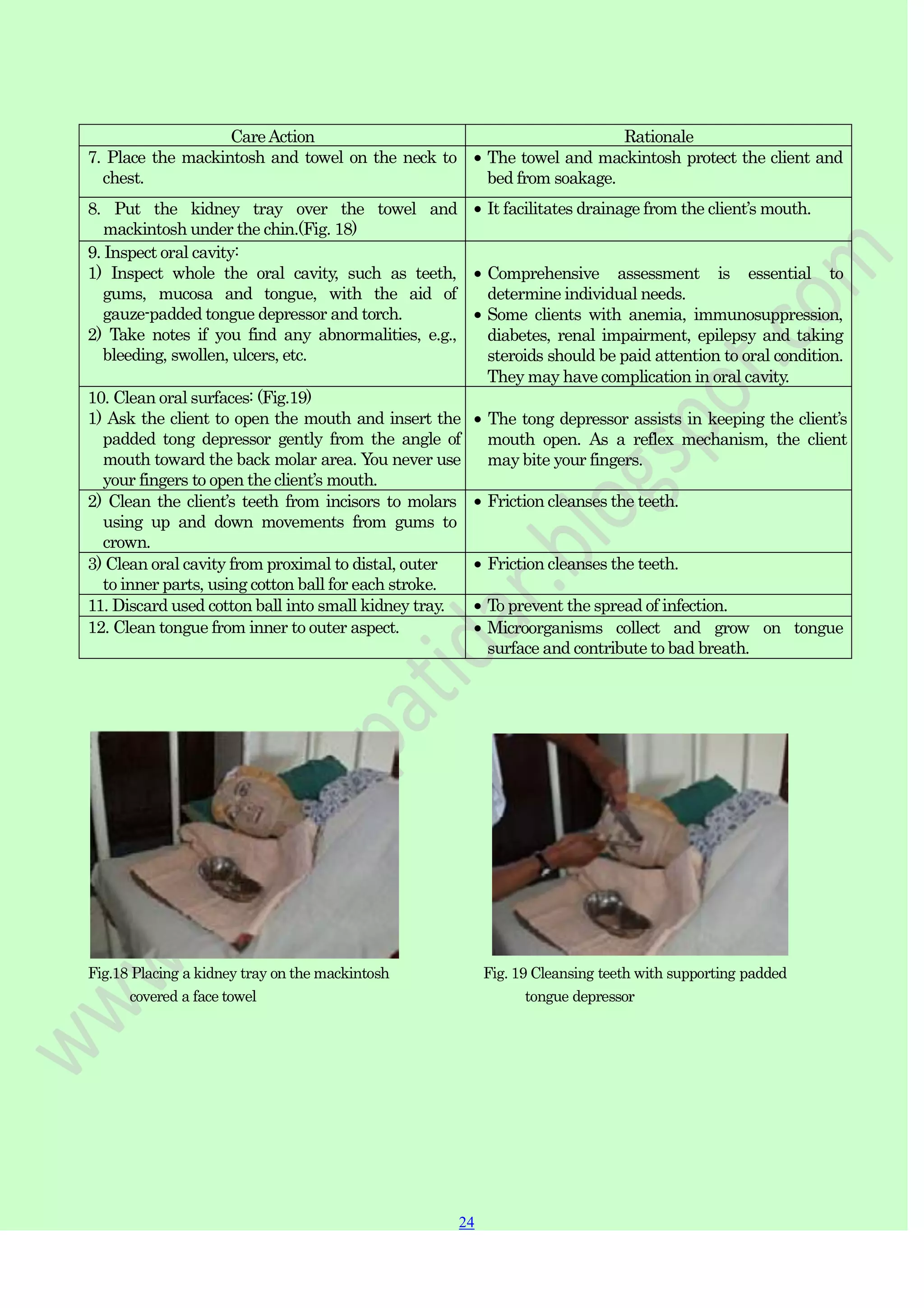 24
24
CareAction Rationale
7. Place the mackintosh and towel on the neck to
chest.
The towel and mackintosh protect the client and
bed from soakage.
8. Put the kidney tray over the towel and
mackintosh under the chin.(Fig. 18)
It facilitates drainage from the client‟s mouth.
9. Inspect oral cavity:
1) Inspect whole the oral cavity, such as teeth,
gums, mucosa and tongue, with the aid of
gauze-padded tongue depressor and torch.
2) Take notes if you find any abnormalities, e.g.,
bleeding, swollen, ulcers, etc.
Comprehensive assessment is essential to
determine individual needs.
Some clients with anemia, immunosuppression,
diabetes, renal impairment, epilepsy and taking
steroids should be paid attention to oral condition.
They may have complication in oral cavity.
10. Clean oral surfaces: (Fig.19)
1) Ask the client to open the mouth and insert the
padded tong depressor gently from the angle of
mouth toward the back molar area. You never use
your fingers to open the client‟s mouth.
The tong depressor assists in keeping the client‟s
mouth open. As a reflex mechanism, the client
may bite your fingers.
2) Clean the client‟s teeth from incisors to molars
using up and down movements from gums to
crown.
Friction cleanses the teeth.
3) Clean oral cavity from proximal to distal, outer
to inner parts, using cotton ball for each stroke.
Friction cleanses the teeth.
11. Discard used cotton ball into small kidney tray. To prevent the spread of infection.
12. Clean tongue from inner to outer aspect. Microorganisms collect and grow on tongue
surface and contribute to bad breath.
Fig.18 Placing a kidney tray on the mackintosh
covered a face towel
Fig. 19 Cleansing teeth with supporting padded
tongue depressor
 