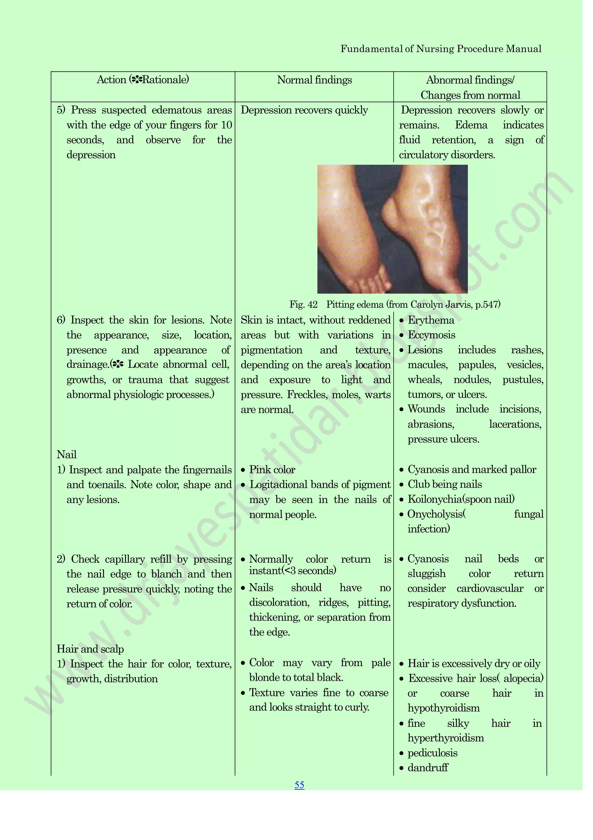 55
55
Fundamental of Nursing Procedure Manual
Action (✽Rationale) Normal findings Abnormal findings/
Changes from normal
5) Press suspected edematous areas
with the edge of your fingers for 10
seconds, and observe for the
depression
Depression recovers quickly Depression recovers slowly or
remains. Edema indicates
fluid retention, a sign of
circulatory disorders.
Fig. 42 Pitting edema (from Carolyn Jarvis, p.547)
6) Inspect the skin for lesions. Note
the appearance, size, location,
presence and appearance of
drainage.(✽ Locate abnormal cell,
growths, or trauma that suggest
abnormal physiologic processes.)
Nail
1) Inspect and palpate the fingernails
and toenails. Note color, shape and
any lesions.
2) Check capillary refill by pressing
the nail edge to blanch and then
release pressure quickly, noting the
return of color.
Hair and scalp
1) Inspect the hair for color, texture,
growth, distribution
Skin is intact, without reddened
areas but with variations in
pigmentation and texture,
depending on the area‟s location
and exposure to light and
pressure. Freckles, moles, warts
are normal.
Pink color
Logitadional bands of pigment
may be seen in the nails of
normal people.
Normally color return is
instant(<3 seconds)
Nails should have no
discoloration, ridges, pitting,
thickening, or separation from
the edge.
Color may vary from pale
blonde to total black.
Texture varies fine to coarse
and looks straight to curly.
Erythema
Eccymosis
Lesions includes rashes,
macules, papules, vesicles,
wheals, nodules, pustules,
tumors, or ulcers.
Wounds include incisions,
abrasions, lacerations,
pressure ulcers.
Cyanosis and marked pallor
Club being nails
Koilonychia(spoon nail)
Onycholysis( fungal
infection)
Cyanosis nail beds or
sluggish color return
consider cardiovascular or
respiratory dysfunction.
Hair is excessively dry or oily
Excessive hair loss( alopecia)
or coarse hair in
hypothyroidism
fine silky hair in
hyperthyroidism
pediculosis
dandruff
 