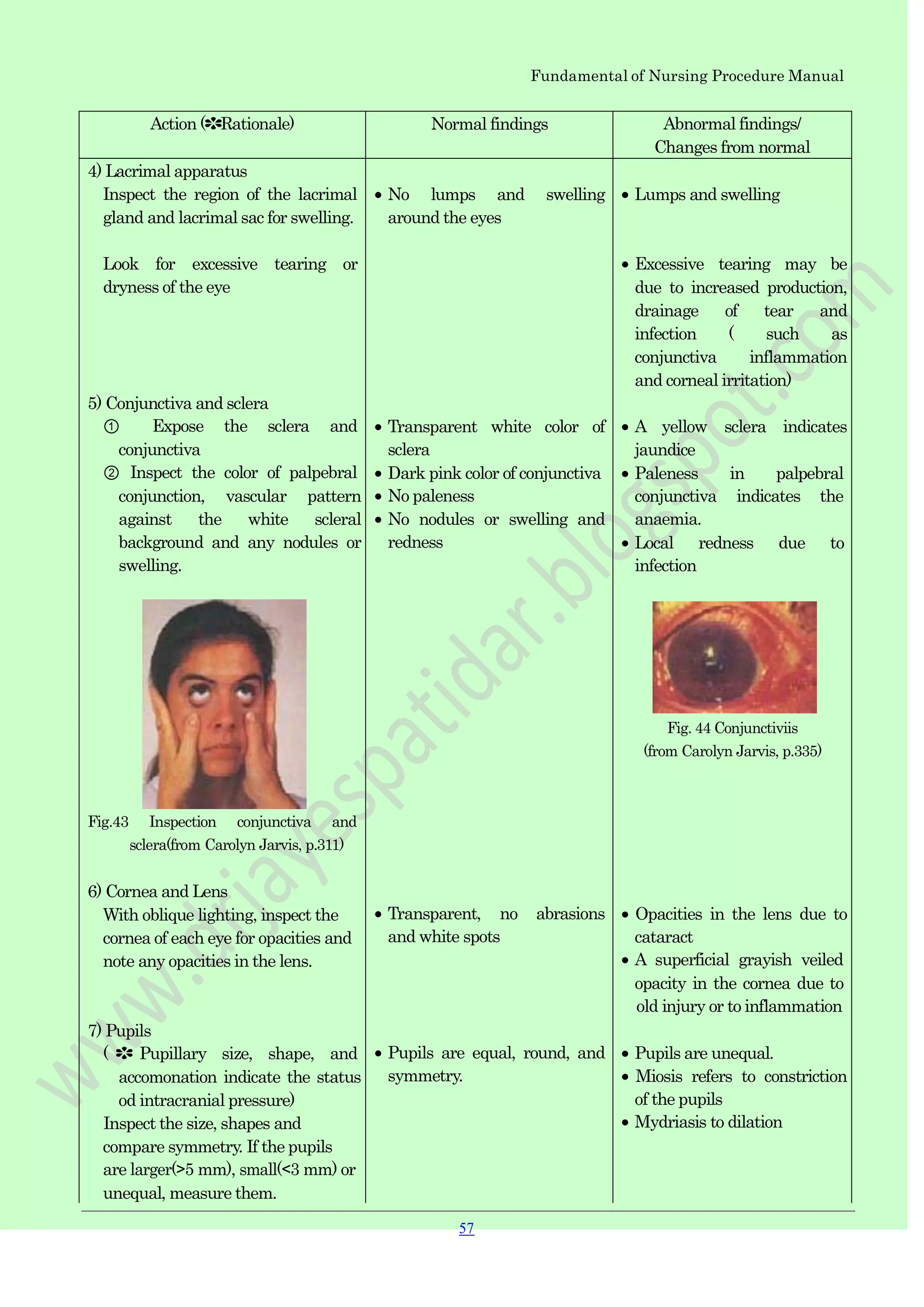Fundamental of Nursing Procedure Manual
Action (✽Rationale) Normal findings Abnormal findings/
Changes from normal
4) Lacrimal apparatus
Inspect the region of the lacrimal
gland and lacrimal sac for swelling.
Look for excessive tearing or
dryness of the eye
5) Conjunctiva and sclera
① Expose the sclera and
conjunctiva
② Inspect the color of palpebral
conjunction, vascular pattern
against the white scleral
background and any nodules or
swelling.
Fig.43 Inspection conjunctiva and
sclera(from Carolyn Jarvis, p.311)
6) Cornea and Lens
With oblique lighting, inspect the
cornea of each eye for opacities and
note any opacities in the lens.
7) Pupils
( ✽ Pupillary size, shape, and
accomonation indicate the status
od intracranial pressure)
Inspect the size, shapes and
compare symmetry. If the pupils
are larger(>5 mm), small(<3 mm) or
unequal, measure them.
No lumps and swelling
around the eyes
Transparent white color of
sclera
Dark pink color of conjunctiva
No paleness
No nodules or swelling and
redness
Transparent, no abrasions
and white spots
Pupils are equal, round, and
symmetry.
Lumps and swelling
Excessive tearing may be
due to increased production,
drainage of tear and
infection ( such as
conjunctiva inflammation
and corneal irritation)
A yellow sclera indicates
jaundice
Paleness in palpebral
conjunctiva indicates the
anaemia.
Local redness due to
infection
Fig. 44 Conjunctiviis
(from Carolyn Jarvis, p.335)
Opacities in the lens due to
cataract
A superficial grayish veiled
opacity in the cornea due to
old injury or to inflammation
Pupils are unequal.
Miosis refers to constriction
of the pupils
Mydriasis to dilation
57
 