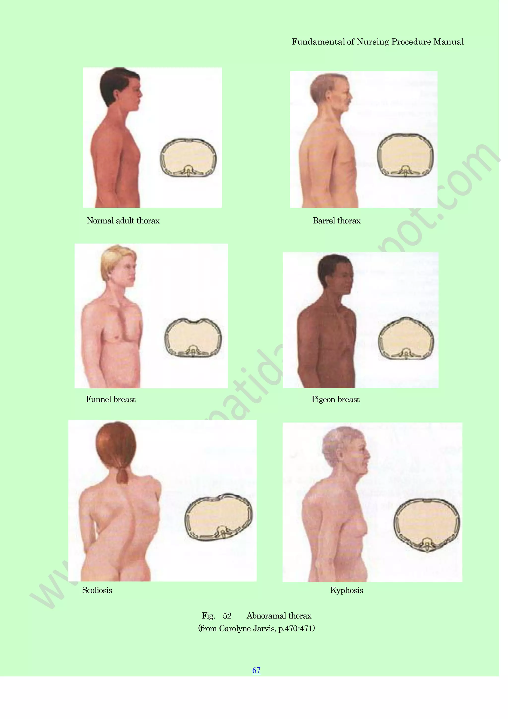 Fundamental of Nursing Procedure Manual
Normal adult thorax Barrel thorax
Funnel breast Pigeon breast
Scoliosis Kyphosis
Fig. 52 Abnoramal thorax
(from Carolyne Jarvis, p.470-471)
67
 