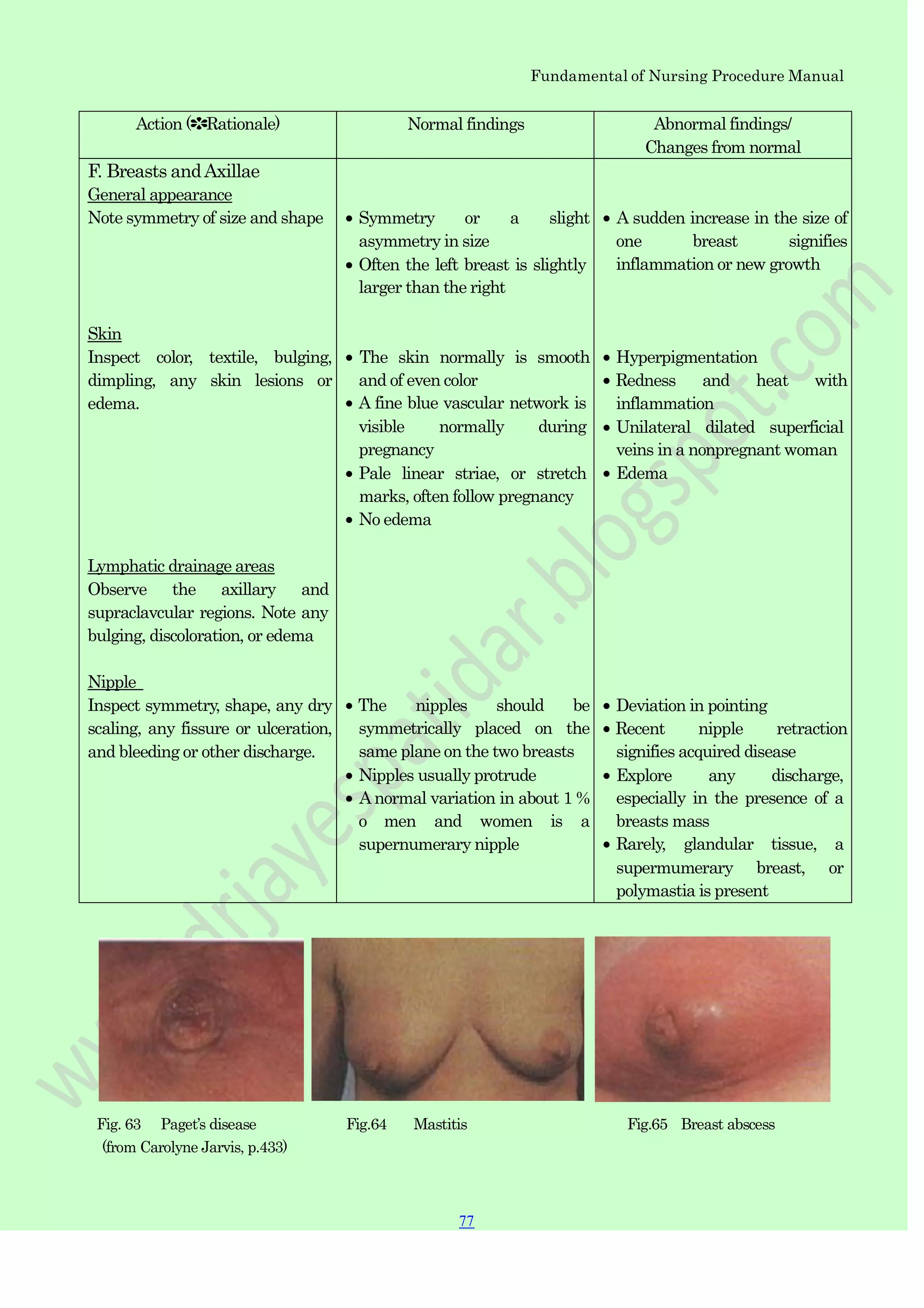 Fundamental of Nursing Procedure Manual
Action (✽Rationale) Normal findings Abnormal findings/
Changes from normal
F. Breasts andAxillae
General appearance
Note symmetry of size and shape
Skin
Inspect color, textile, bulging,
dimpling, any skin lesions or
edema.
Lymphatic drainage areas
Observe the axillary and
supraclavcular regions. Note any
bulging, discoloration, or edema
Nipple
Inspect symmetry, shape, any dry
scaling, any fissure or ulceration,
and bleeding or other discharge.
Symmetry or a slight
asymmetry in size
Often the left breast is slightly
larger than the right
The skin normally is smooth
and of even color
A fine blue vascular network is
visible normally during
pregnancy
Pale linear striae, or stretch
marks, often follow pregnancy
No edema
The nipples should be
symmetrically placed on the
same plane on the two breasts
Nipples usually protrude
A normal variation in about 1 %
o men and women is a
supernumerary nipple
A sudden increase in the size of
one breast signifies
inflammation or new growth
Hyperpigmentation
Redness and heat with
inflammation
Unilateral dilated superficial
veins in a nonpregnant woman
Edema
Deviation in pointing
Recent nipple retraction
signifies acquired disease
Explore any discharge,
especially in the presence of a
breasts mass
Rarely, glandular tissue, a
supermumerary breast, or
polymastia is present
Fig. 63 Paget‟s disease Fig.64 Mastitis Fig.65 Breast abscess
(from Carolyne Jarvis, p.433)
77
 